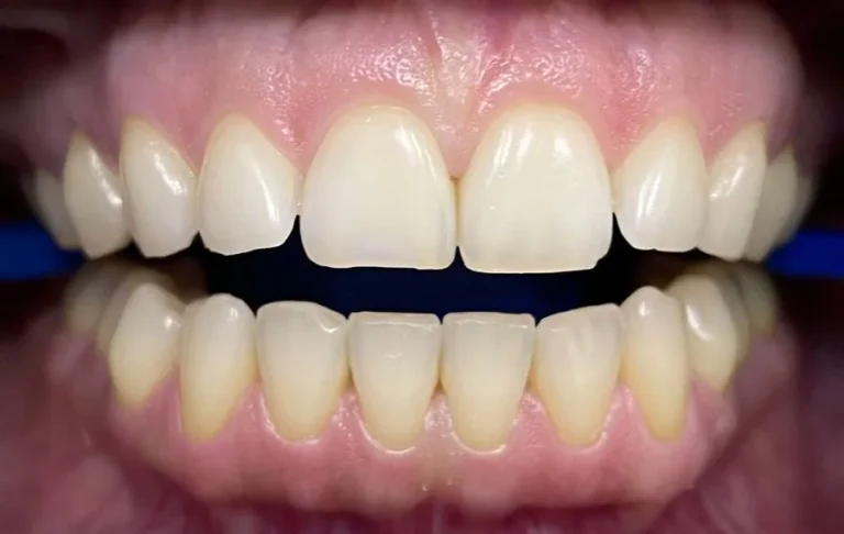 Teeth-Whitening-BA-03