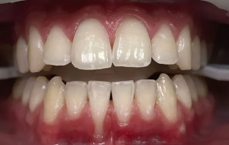 Teeth-Whitening-BA-06