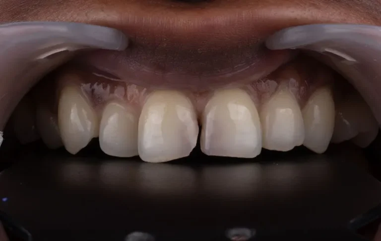 Vaneer-BA-11