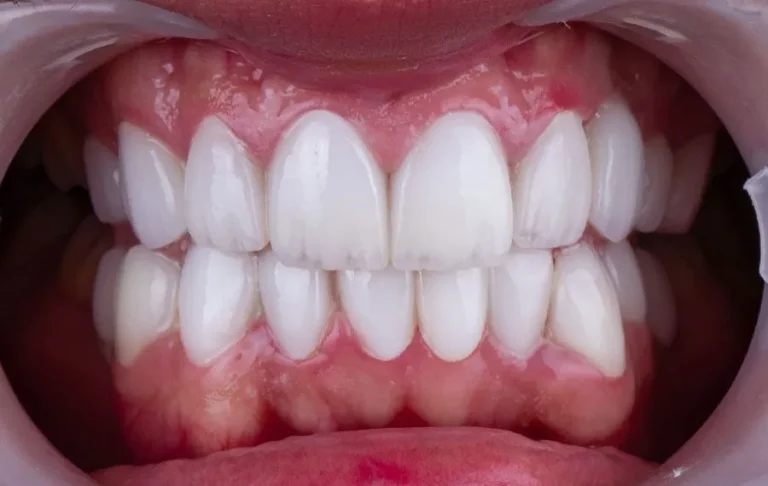 crowns-veneer-a