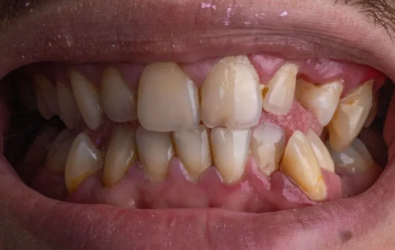 crowns-veneer-b