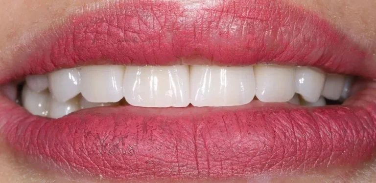 dental-implant-BA-08
