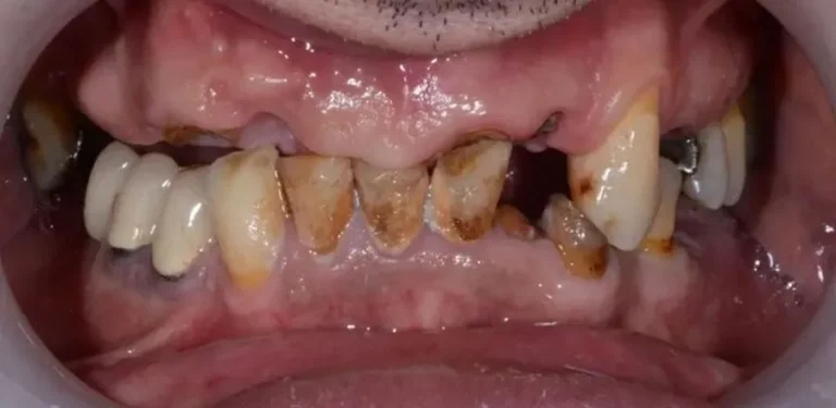 dental-implant-BA-11